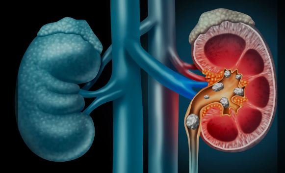 Kidney Stones Management